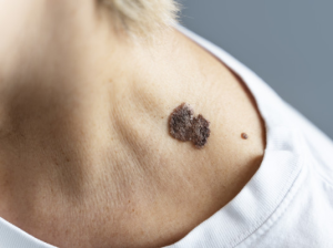 melanoma időskorban