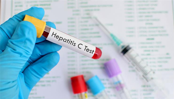 hepatitis c