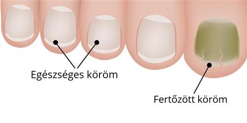 körömgomba körömgomba
