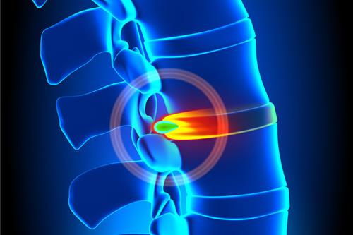 a porckorongsérv rendkívül fájdalmas betegség a porckorongsérv rendkívül fájdalmas betegség